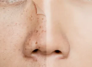 Chữa nám tàn nhang tại spa và viện thẩm mỹ