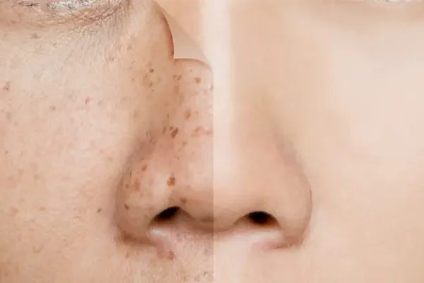 Chữa nám tàn nhang tại spa và viện thẩm mỹ