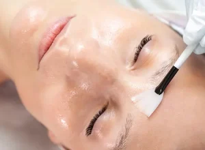 Có nên peel da trị nám không