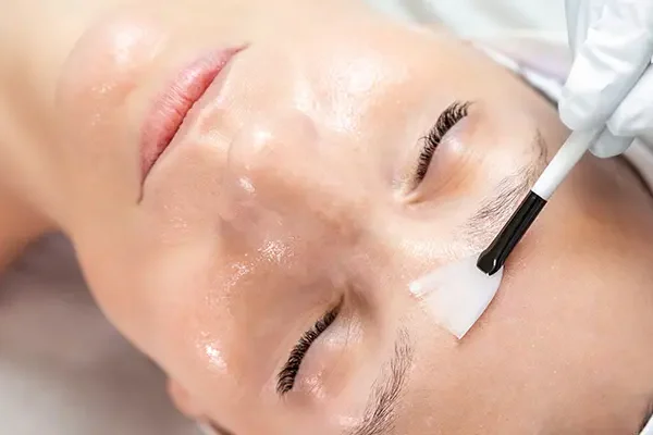 Có nên peel da trị nám không