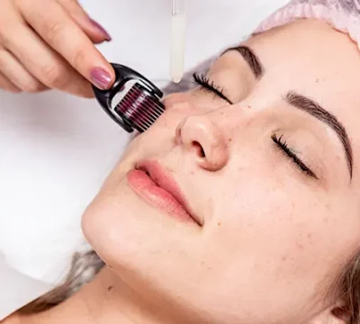Có nên lăn kim trị nám không?
