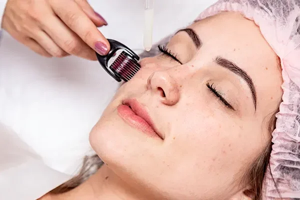 Có nên lăn kim trị nám không?