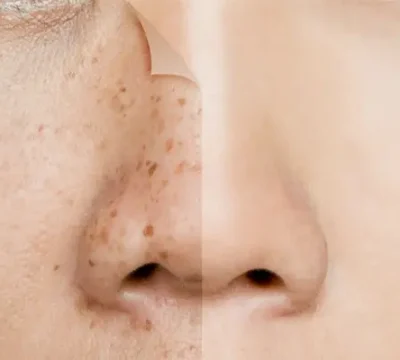 Điều Trị Nám Da Mặt Và Tàn Nhang Ở Đâu Uy Tín