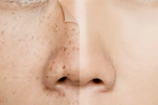 Điều Trị Nám Da Mặt Và Tàn Nhang Ở Đâu Uy Tín