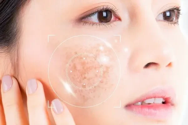 Cách điều trị nám mảng và bảng giá dịch vụ điều trị nám
