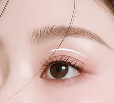 Khi Nào Nên Nâng Cơ Mí Mắt?