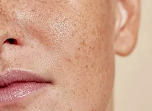 Cách trị nám da mặt hiệu quả cho người bị nám lâu năm