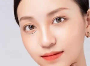 Nguyên nhân bọng mắt dưới là gì?