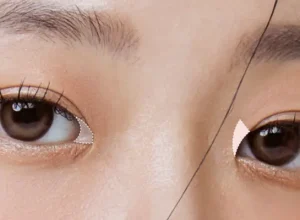 Phẫu Thuật Mở Góc Mắt Là Gì?