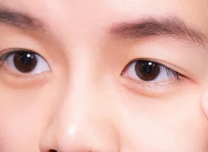 Vì sao tự nhiên bị sụp mí mắt?