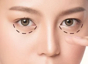 Xóa bọng mắt, trị quầng thâm mắt